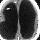 Hombre no posee cerebro y lleva vida normal