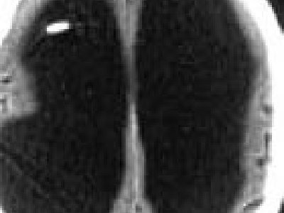 Hombre que casi no posee Cerebro lleva una Vida Normal