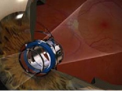 Ojo cibernético para personas que poseen problemas de Visión