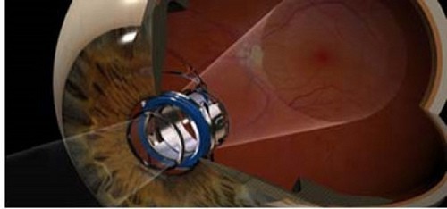 visioncare zoom ojo