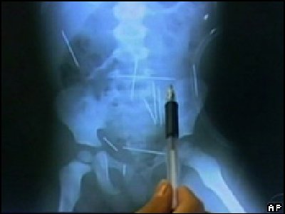 Un pequeño de dos años posee 50 agujas en todo su cuerpo