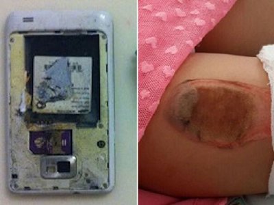 Niña resulta herida por la explosión de Samsung Galaxy S2 en su bolsillo