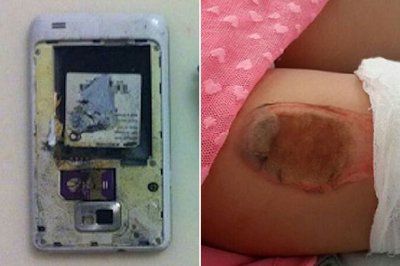 Niña resulta herida por la explosión de Samsung Galaxy S2 en su bolsillo